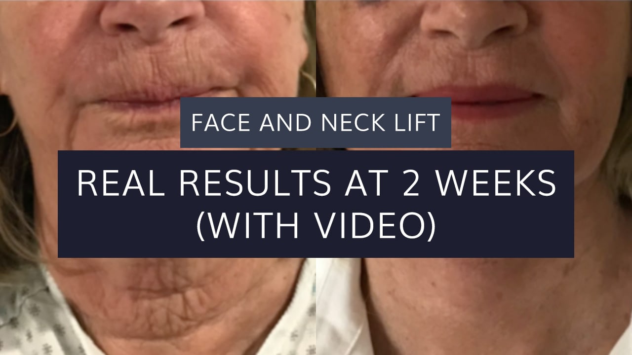 Face and Neck Lift: Real Results at 2 Weeks (with video) | Jason Martin ...